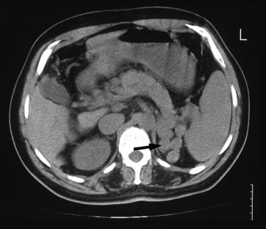 A 52-year-old man with known hepatitis B cirrhosis