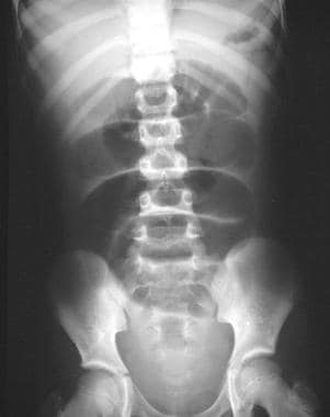 Plain abdominal radiograph in a 9-year-old patient