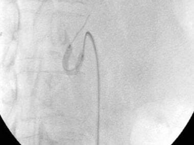 A-5: Digital subtraction angiogram obtained during