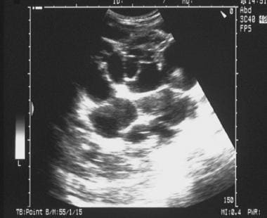 Sonogram of the kidney in a patient with polycysti