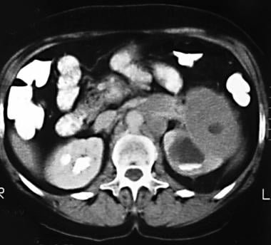 Contrast-enhanced computed tomography (CT) scan in
