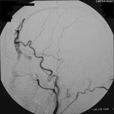 Selective right external carotid angiogram in a pa