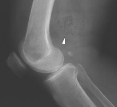 Lateral radiograph of the knee shows multiple tiny
