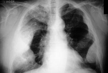 Chest radiograph shows expansion of multiple ribs 