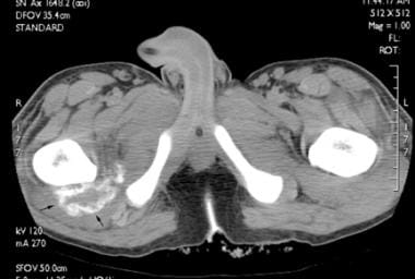 Axial computed tomography (CT) scan in a male pati