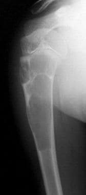 A 7-year-old boy with a simple bone cyst in the up