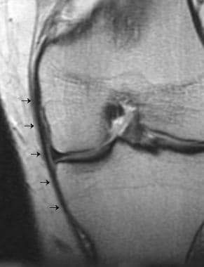 Grade I medial collateral ligament tear with surro