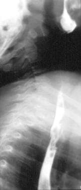 Barium esophagram (obtained in the same patient as