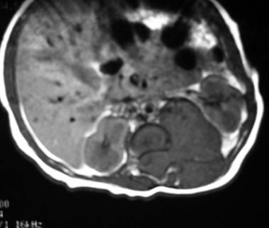 Axial nonenhanced T1-weighted MRI shows a hypointe