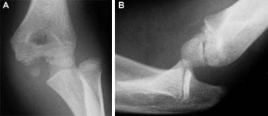 Posterolateral elbow dislocation. (A) Note the avu