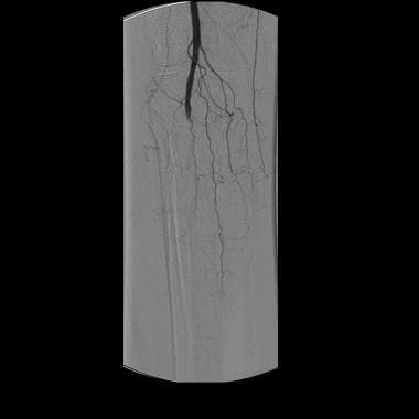 A 68-year-old female with acute right lower extrem