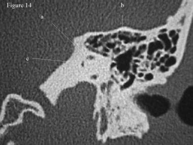 CT scan, temporal bone. This section passes throug