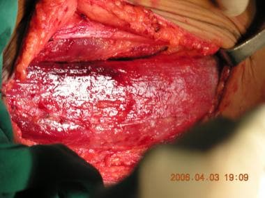 The gracilis muscle dissected; the proximal half i