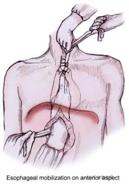 Esophageal mobilization on anterior aspect