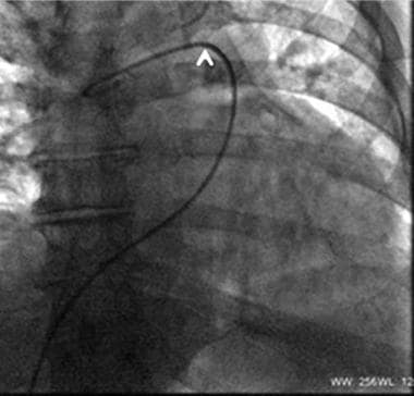 Tip of catheter in the right pulmonary artery. A g