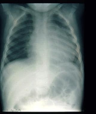 Child with pericardial effusion due to systemic on