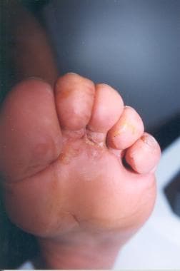 Gram Negative Toe Web Infection Background Pathophysiology - 