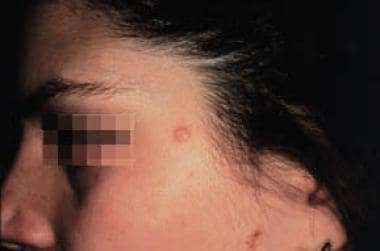 Clinical appearance of trichofolliculoma. 