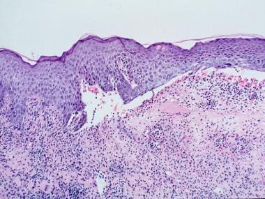 bullous impetigo histology