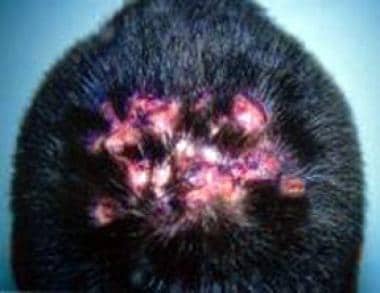 A white patient with painful nodules. Image used w