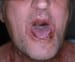 Oral Manifestations of Autoimmune Blistering Diseases