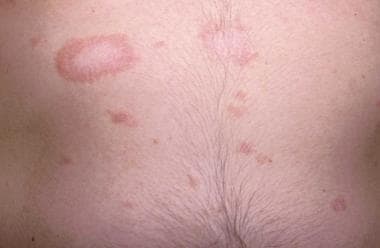 Pityriasis Rosea Background Pathophysiology Etiology