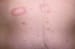 Pityriasis Rosea