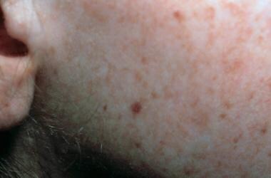 Face of a toddler with xeroderma pigmentosum, repr