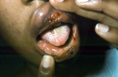 Erythema multiforme of the oral mucosa. Courtesy o