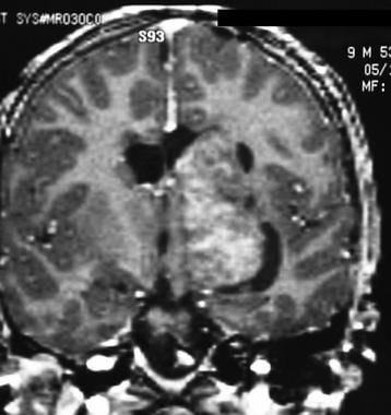 Coronal T1-weighted gadolinium-enhanced MRI of the