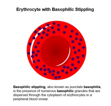 Basophilic stippling in lead poisoning.