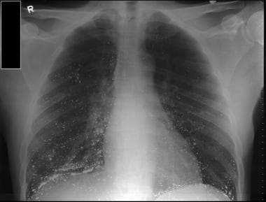 Image: Chest X-Ray of a Patient with Fluid in Minor and Major Fissures -  Merck Manuals Professional Edition