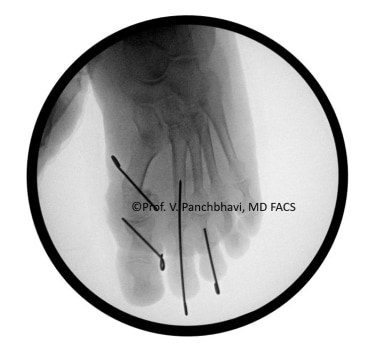 Hammertoe Deformity Treatment