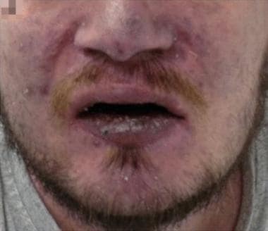 Cyanosis. Facial cyanosis in a patient with chroni