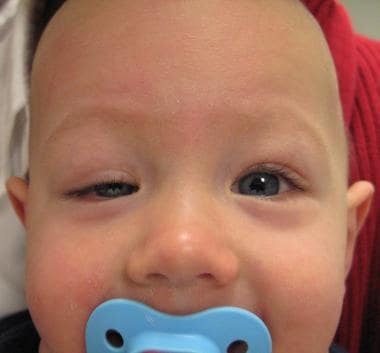 Congenital ptosis of the right eye. 