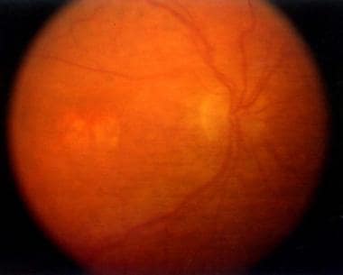 Fundus picture of the same patient with central re