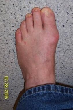 Hallux rigidus