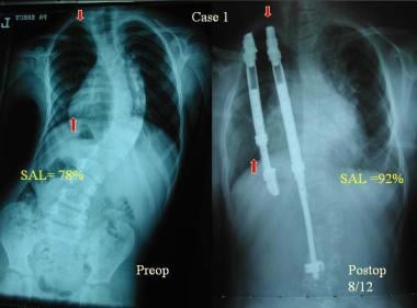 Preoperative and postoperative radiographs show in
