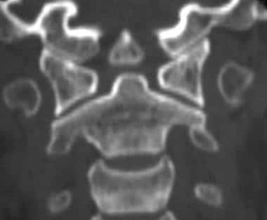 A coronal reconstruction of an orthotopic os odont