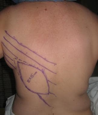 Preoperative markings. 