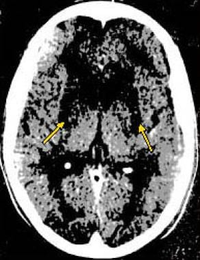 Computed tomography (CT) scan in a 15-year-old boy