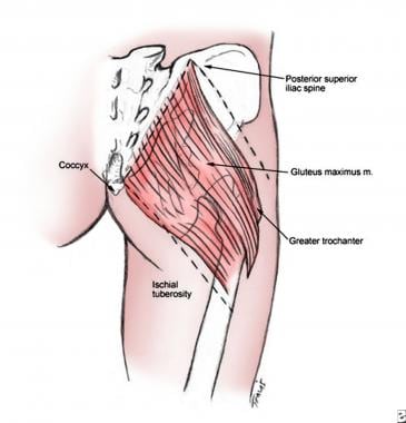 Landmarks for superior gluteal artery, on which su