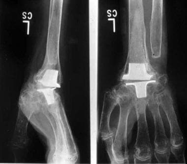 Wrist arthroplasty in rheumatoid arthritis of the 