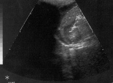 Ultrasound image of right flank. Clear hypoechoic 