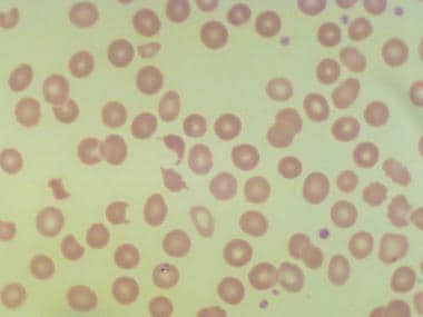 Schistocytes (thrombotic thrombocytopenic purpura)