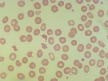 hemolytic disease of the newborn blood smear