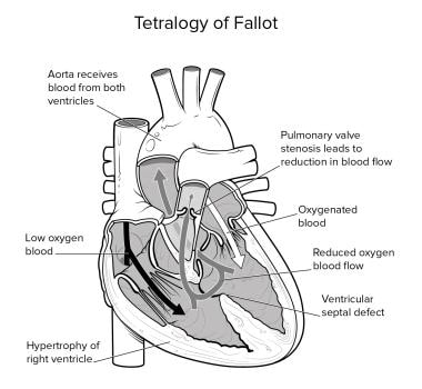 Anatomic findings in tetralogy of Fallot are depic