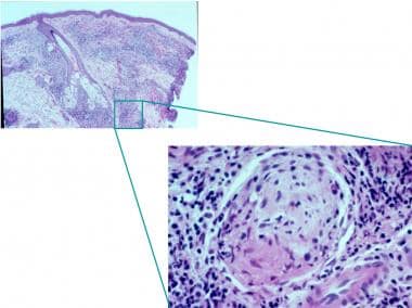 mycobacterium leprae acid fast