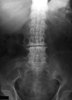 Mechanical bowel obstruction due to a left colon c