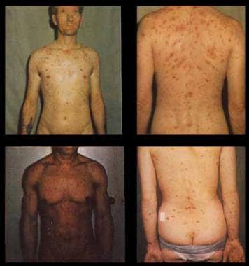 early syphilis in men